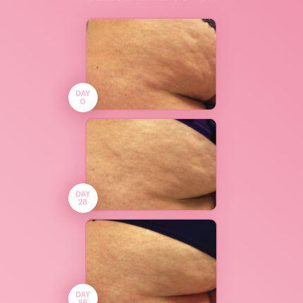 cellulite reduction cream 