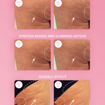 stretch mark reduction moisturizer breast skin care